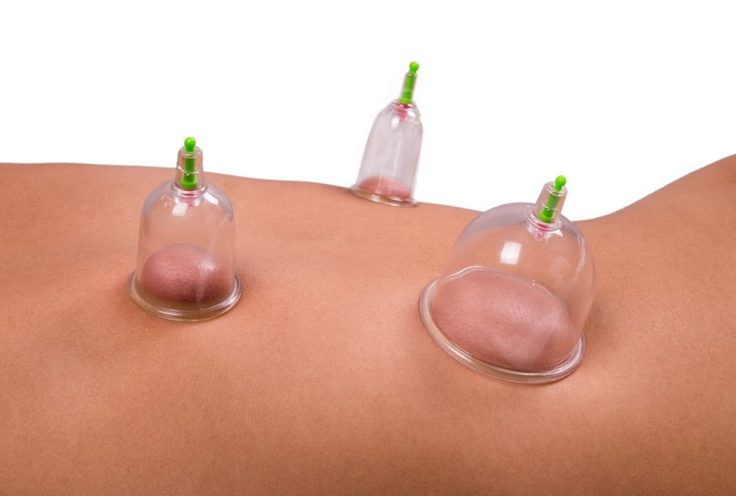 image-752519-mfd-cupping.jpg